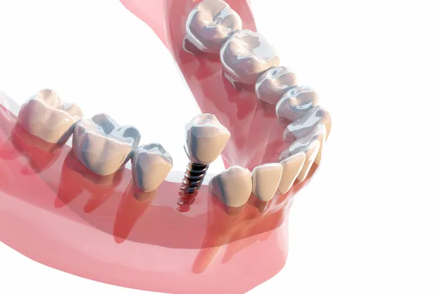 難症例のインプラント治療にも対応​