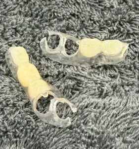 ノンクラスプデンチャー