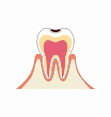 虫歯がエナメル質まで進んだ段階