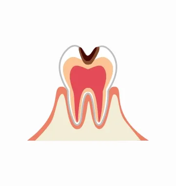 虫歯が象牙質まで進んだ段階