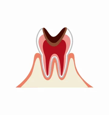 虫歯が歯髄まで進んだ段階