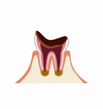 虫歯が歯根まで進んだ段階