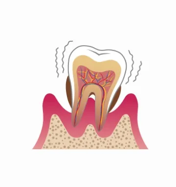 重度歯周炎