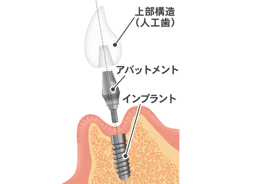 インプラントの構造