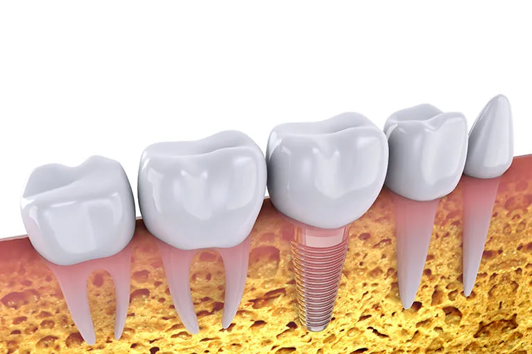 インプラント治療についての質問